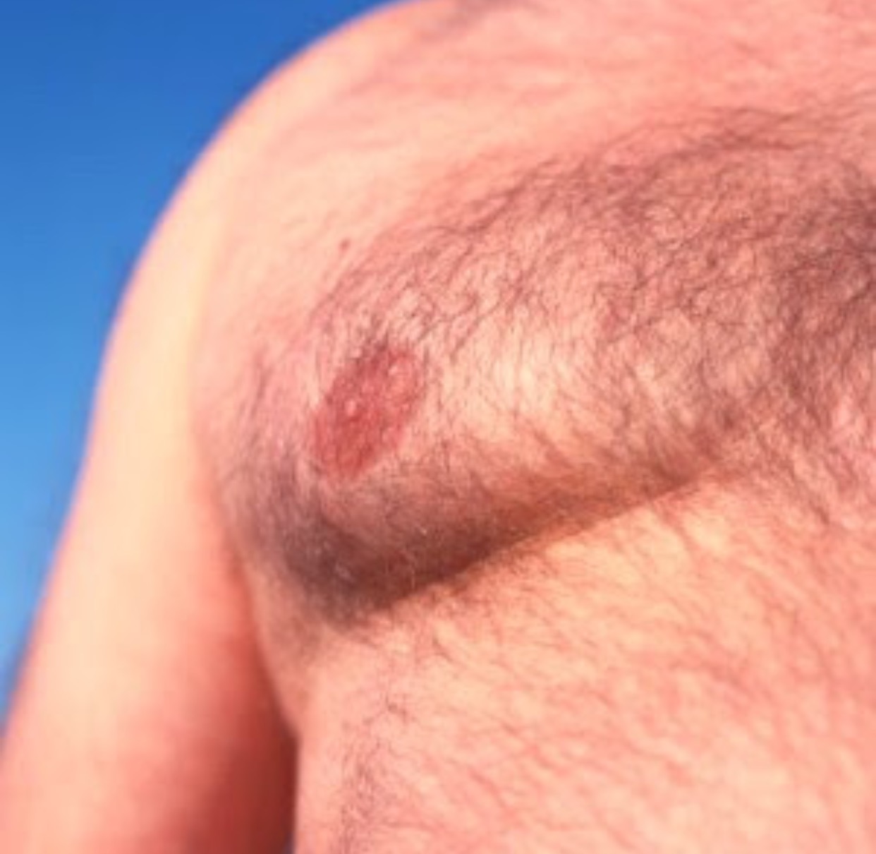 уплотнение под кожей в груди у мужчин фото 91
