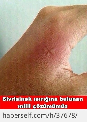 Sadece Kronik Sivrisinek Kurbanlarının Anlayacağı 15 Durum