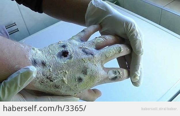 İnsan Eti Yiyen Uyuşturucu: Krokodil'in Mahvettiği Hayatlardan 11 Kare (+18)