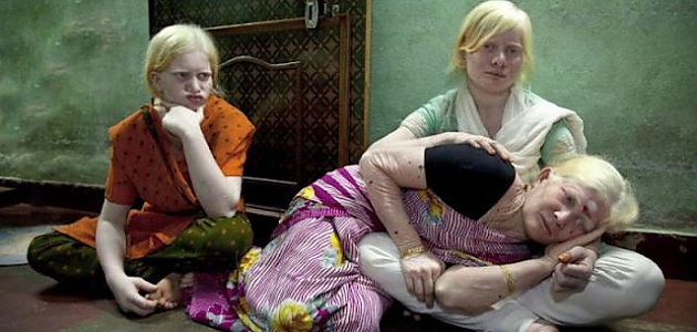 Tüm Bireyleri Albino Olan Ailenin Birbirinden İlginç 16 Fotoğrafı