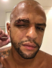 felipe melo nun kaşının yarılması / #1343638