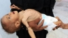 yemen de 85 bin çocuğun açlıktan ölmesi / #1765522