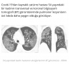 koronavirüsün röntgen ve tomografi görüntüleri